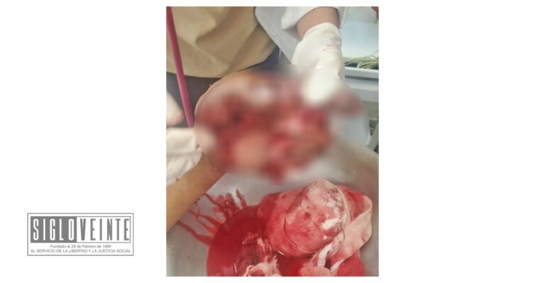 En San Lucas, una persona estuvo a punto de perder la mano por la detonación de juego pirotécnico