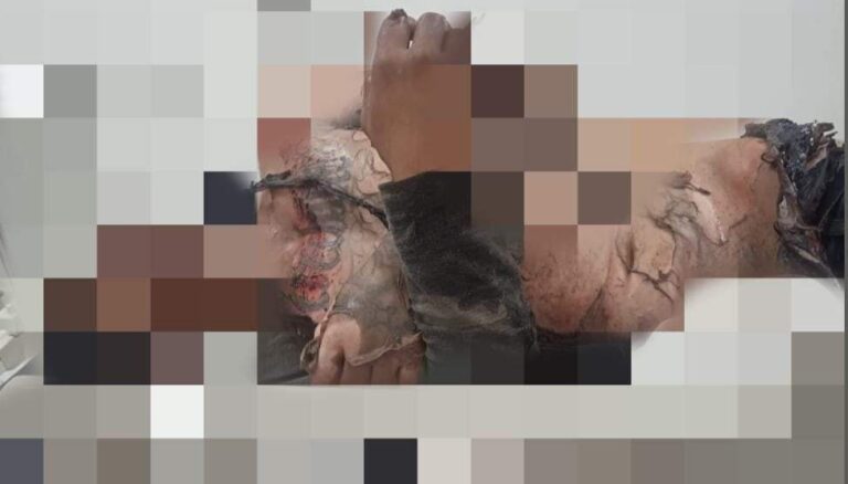 En Zitácuaro, un hombre rocía con gasolina a su «amigo» y le prende fuego