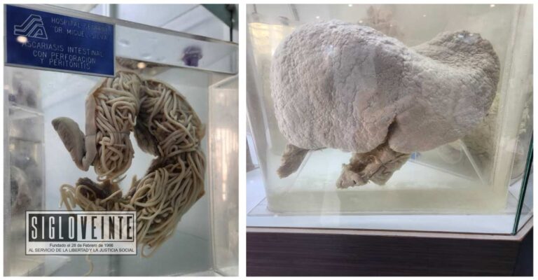Conoce más sobre las principales causas de muerte en el Museo de Patología del Hospital Civil de Morelia